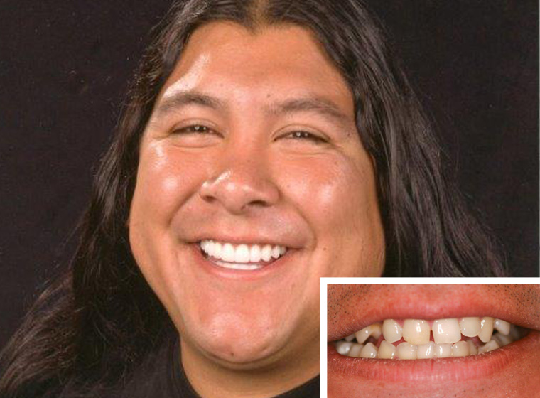 Close-up of an Oceanside dental crowns patient.