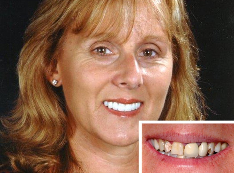 Close-up of a Fallbrook dental crowns patient.