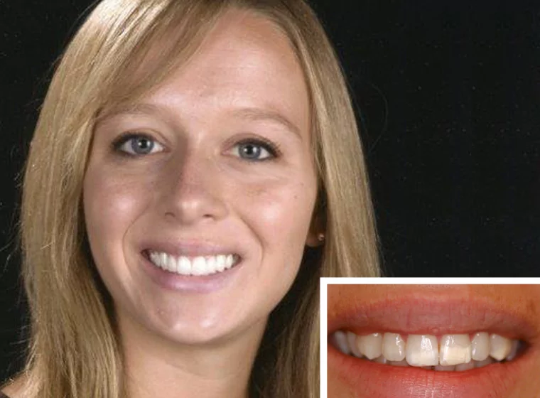 Patient who received aesthetic dentistry work near Fallbrook CA.