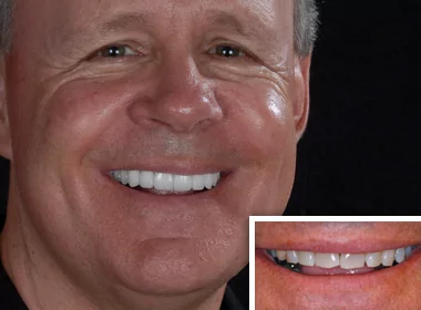 Close-up of a Vista, CA dental crowns patient.