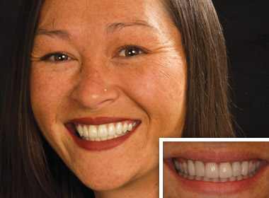 Tiffany-Before and After photos of a sedation dentistry patient of Dr. Dankworth near Vista