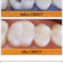 cerec-before-after-1