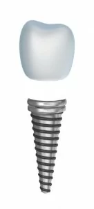 Diagram of a dental crown similar to the ones used at our practice in Oceanside, CA