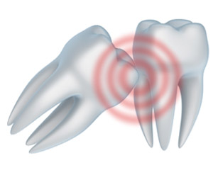 A tooth extraction near Fallbrook and Vista CA can help those with impacted wisdom teeth.