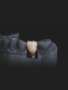 A graphic image of a dental implant.