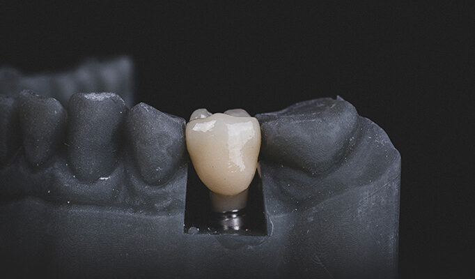A graphic image of a dental implant.