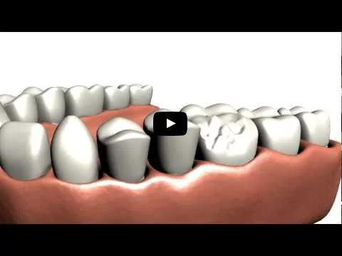 Video describing dental crowns